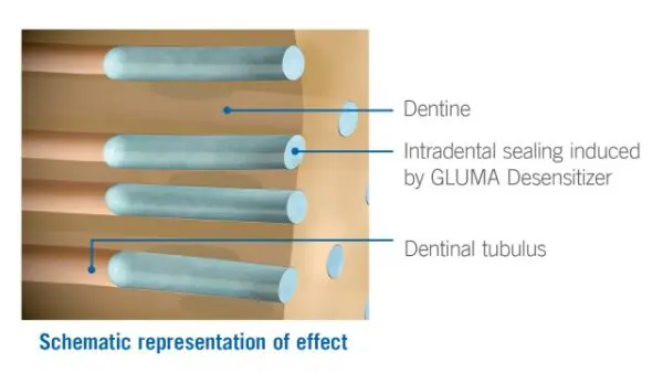 Kulzer Gluma Desensitiser 1 x 5ml - Image 2