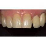 Nichrominox Set of 2 Palatal Contrastors - Image 3
