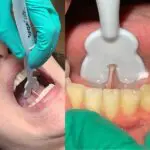Armor Dental Tongue Guide - Image 2