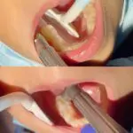 Armor Dental Comfort Soft - Single Patient - Image 3