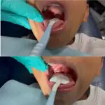 Armor Dental Comfort Soft - Single Patient - Image 2