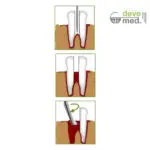Devemed Root Elevator Winter - Image 2